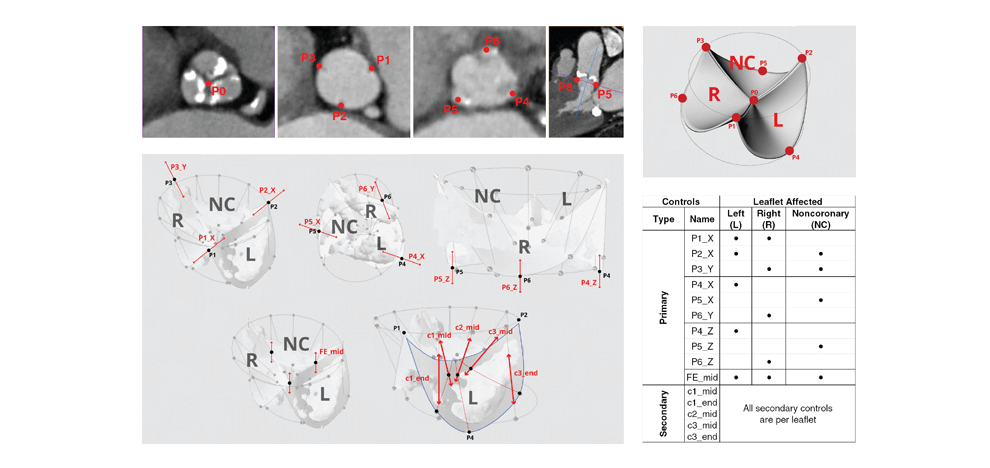 pre-procedural-fit-testing-transcatheter-aortic-valve-replacement-tavr-valves-using-parametric-modeling-3d-printing-3 pre-procedural-fit-testing-transcatheter-aortic-valve-replacement-tavr-valves-using-parametric-modeling-3d-printing-3